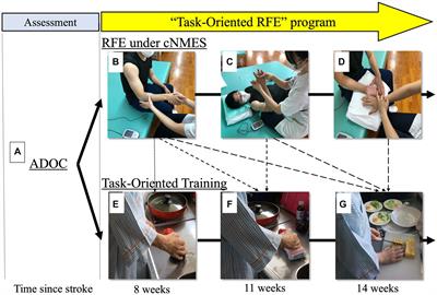 Combined repetitive facilitative exercise under continuous neuromuscular electrical stimulation and task-oriented training for hemiplegic upper extremity during convalescent phase after stroke: before-and-after feasibility trial